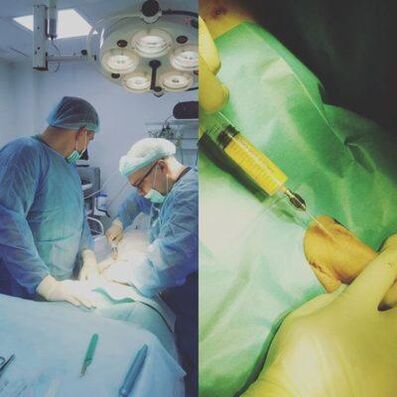 Un engrosamento do pene é posible coa axuda dunha operación